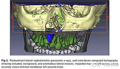正畸文獻(xiàn)閱讀--單側(cè)唇腭裂患者的多學(xué)科綜合序列治療 正畸文獻(xiàn)閱讀--單側(cè)唇腭裂患者的多學(xué)科綜合序列治療