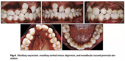 正畸文獻(xiàn)閱讀--單側(cè)唇腭裂患者的多學(xué)科綜合序列治療 正畸文獻(xiàn)閱讀--單側(cè)唇腭裂患者的多學(xué)科綜合序列治療