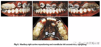 正畸文獻(xiàn)閱讀--單側(cè)唇腭裂患者的多學(xué)科綜合序列治療 正畸文獻(xiàn)閱讀--單側(cè)唇腭裂患者的多學(xué)科綜合序列治療