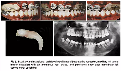 正畸文獻(xiàn)閱讀--單側(cè)唇腭裂患者的多學(xué)科綜合序列治療 正畸文獻(xiàn)閱讀--單側(cè)唇腭裂患者的多學(xué)科綜合序列治療