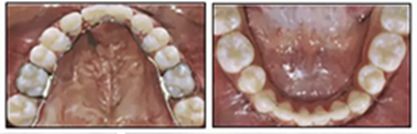 正畸文獻(xiàn)閱讀--單側(cè)唇腭裂患者的多學(xué)科綜合序列治療 正畸文獻(xiàn)閱讀--單側(cè)唇腭裂患者的多學(xué)科綜合序列治療