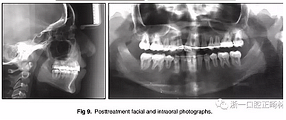正畸文獻(xiàn)閱讀--單側(cè)唇腭裂患者的多學(xué)科綜合序列治療 正畸文獻(xiàn)閱讀--單側(cè)唇腭裂患者的多學(xué)科綜合序列治療