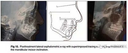 正畸文獻(xiàn)閱讀--單側(cè)唇腭裂患者的多學(xué)科綜合序列治療 正畸文獻(xiàn)閱讀--單側(cè)唇腭裂患者的多學(xué)科綜合序列治療