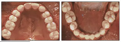 正畸文獻(xiàn)閱讀--單側(cè)唇腭裂患者的多學(xué)科綜合序列治療 正畸文獻(xiàn)閱讀--單側(cè)唇腭裂患者的多學(xué)科綜合序列治療