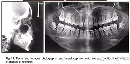 正畸文獻(xiàn)閱讀--單側(cè)唇腭裂患者的多學(xué)科綜合序列治療 正畸文獻(xiàn)閱讀--單側(cè)唇腭裂患者的多學(xué)科綜合序列治療