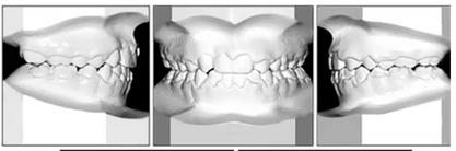 正畸文獻(xiàn)閱讀--單側(cè)唇腭裂患者的多學(xué)科綜合序列治療 正畸文獻(xiàn)閱讀--單側(cè)唇腭裂患者的多學(xué)科綜合序列治療