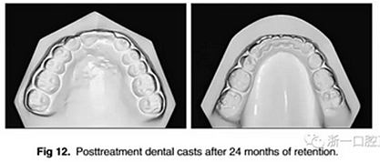 正畸文獻(xiàn)閱讀--單側(cè)唇腭裂患者的多學(xué)科綜合序列治療 正畸文獻(xiàn)閱讀--單側(cè)唇腭裂患者的多學(xué)科綜合序列治療