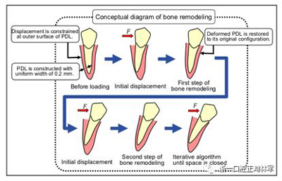 正畸文獻閱讀--對于滑動法關(guān)閉間隙的有限元分析 正畸文獻閱讀--對于滑動法關(guān)閉間隙的有限元分析
