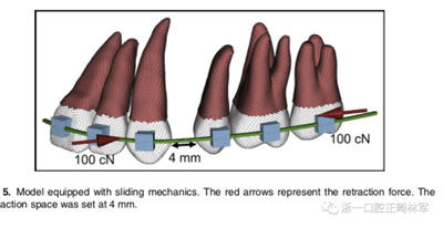 正畸文獻閱讀--對于滑動法關(guān)閉間隙的有限元分析 正畸文獻閱讀--對于滑動法關(guān)閉間隙的有限元分析