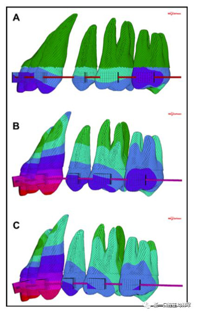 正畸文獻閱讀--對于滑動法關(guān)閉間隙的有限元分析 正畸文獻閱讀--對于滑動法關(guān)閉間隙的有限元分析