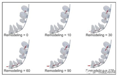 正畸文獻閱讀--對于滑動法關(guān)閉間隙的有限元分析 正畸文獻閱讀--對于滑動法關(guān)閉間隙的有限元分析