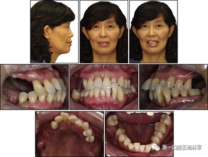 文獻優(yōu)秀正畸病例賞析--多顆牙齒缺失的牙周炎患者的跨學(xué)科綜合治療 文獻優(yōu)秀正畸病例賞析--多顆牙齒缺失的牙周炎患者的跨學(xué)科綜合治療