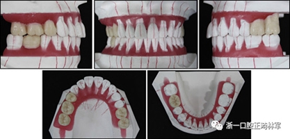 文獻優(yōu)秀正畸病例賞析--多顆牙齒缺失的牙周炎患者的跨學(xué)科綜合治療 文獻優(yōu)秀正畸病例賞析--多顆牙齒缺失的牙周炎患者的跨學(xué)科綜合治療