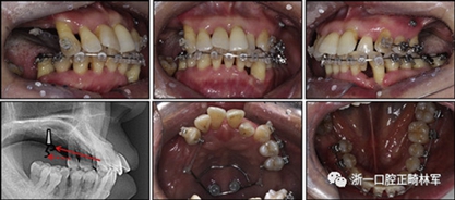 文獻優(yōu)秀正畸病例賞析--多顆牙齒缺失的牙周炎患者的跨學(xué)科綜合治療 文獻優(yōu)秀正畸病例賞析--多顆牙齒缺失的牙周炎患者的跨學(xué)科綜合治療
