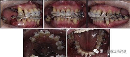 文獻優(yōu)秀正畸病例賞析--多顆牙齒缺失的牙周炎患者的跨學(xué)科綜合治療 文獻優(yōu)秀正畸病例賞析--多顆牙齒缺失的牙周炎患者的跨學(xué)科綜合治療