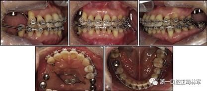 文獻優(yōu)秀正畸病例賞析--多顆牙齒缺失的牙周炎患者的跨學(xué)科綜合治療 文獻優(yōu)秀正畸病例賞析--多顆牙齒缺失的牙周炎患者的跨學(xué)科綜合治療
