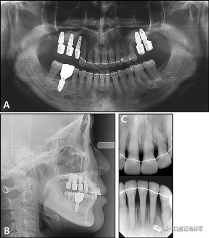 文獻優(yōu)秀正畸病例賞析--多顆牙齒缺失的牙周炎患者的跨學(xué)科綜合治療 文獻優(yōu)秀正畸病例賞析--多顆牙齒缺失的牙周炎患者的跨學(xué)科綜合治療