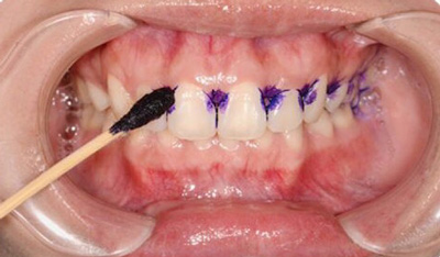 99%的人都不知道怎樣才算把牙齒刷干凈了！