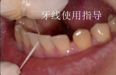 99%的人都不知道怎樣才算把牙齒刷干凈了！