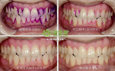 99%的人都不知道怎樣才算把牙齒刷干凈了！