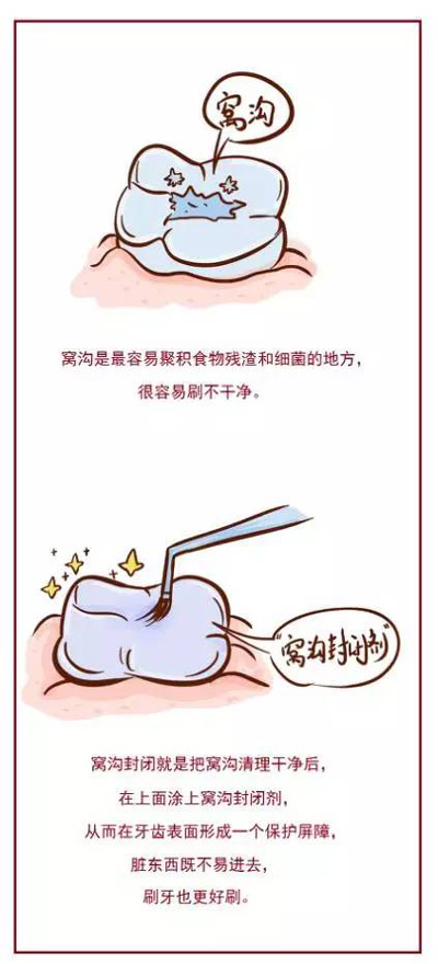 窩溝封閉丨孩子牙齒的“鎧甲勇士” 窩溝封閉丨孩子牙齒的“鎧甲勇士”