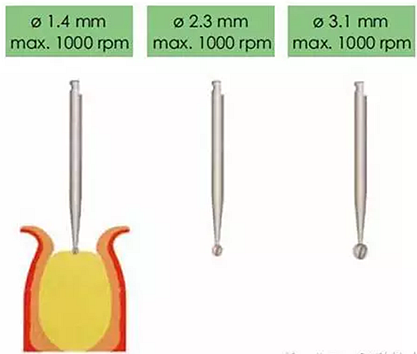 Sraumann種植系統(tǒng)外科操作流程 Sraumann種植系統(tǒng)外科操作流程