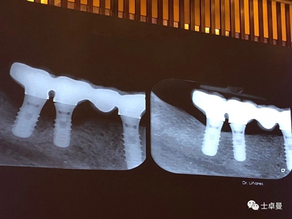 從風(fēng)險(xiǎn)因素控制到及時(shí)有效治療，Dr. Laurence Adriaens深度解析種植體周圍炎的防治