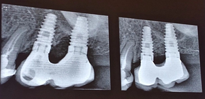 從風(fēng)險(xiǎn)因素控制到及時(shí)有效治療，Dr. Laurence Adriaens深度解析種植體周圍炎的防治