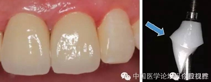 手把手教你做種植軟組織成形 手把手教你做種植軟組織成形