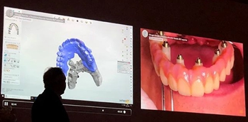 課堂筆記 | 看大師如何運(yùn)用數(shù)字化流程解決復(fù)雜病例 課堂筆記 | 看大師如何運(yùn)用數(shù)字化流程解決復(fù)雜病例