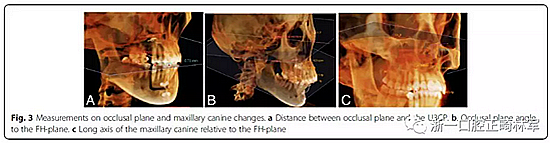 正畸文獻閱讀--用舌側滑動牽引系統(tǒng)控制前牙區(qū)段:初步的CBCT研究 正畸文獻閱讀--用舌側滑動牽引系統(tǒng)控制前牙區(qū)段:初步的CBCT研究