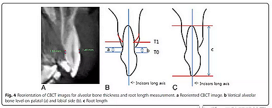 正畸文獻閱讀--用舌側滑動牽引系統(tǒng)控制前牙區(qū)段:初步的CBCT研究 正畸文獻閱讀--用舌側滑動牽引系統(tǒng)控制前牙區(qū)段:初步的CBCT研究
