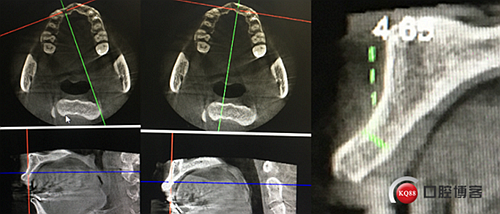 上前牙骨量不足種植+信封式植骨(梁光強(qiáng)) 上前牙骨量不足種植+信封式植骨(梁光強(qiáng))