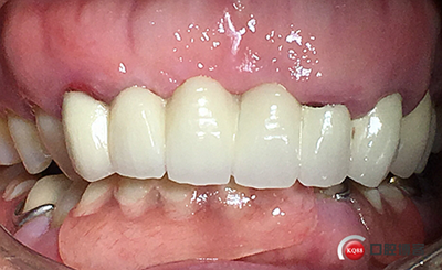 上前牙骨量不足種植+信封式植骨(梁光強(qiáng)) 上前牙骨量不足種植+信封式植骨(梁光強(qiáng))