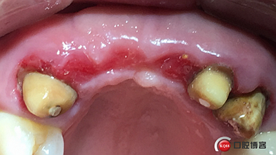 上前牙骨量不足種植+信封式植骨(梁光強(qiáng)) 上前牙骨量不足種植+信封式植骨(梁光強(qiáng))