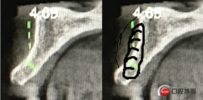 上前牙骨量不足種植+信封式植骨(梁光強(qiáng)) 上前牙骨量不足種植+信封式植骨(梁光強(qiáng))