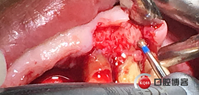 上前牙骨量不足種植+信封式植骨(梁光強(qiáng)) 上前牙骨量不足種植+信封式植骨(梁光強(qiáng))