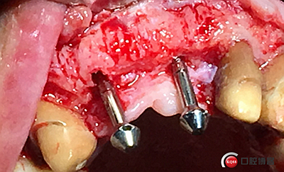 上前牙骨量不足種植+信封式植骨(梁光強(qiáng)) 上前牙骨量不足種植+信封式植骨(梁光強(qiáng))