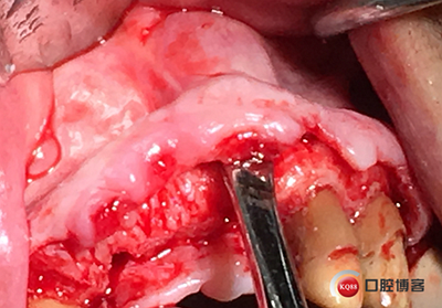 上前牙骨量不足種植+信封式植骨(梁光強(qiáng)) 上前牙骨量不足種植+信封式植骨(梁光強(qiáng))