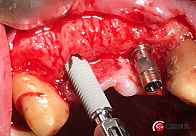 上前牙骨量不足種植+信封式植骨(梁光強(qiáng)) 上前牙骨量不足種植+信封式植骨(梁光強(qiáng))