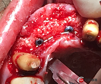 上前牙骨量不足種植+信封式植骨(梁光強(qiáng)) 上前牙骨量不足種植+信封式植骨(梁光強(qiáng))