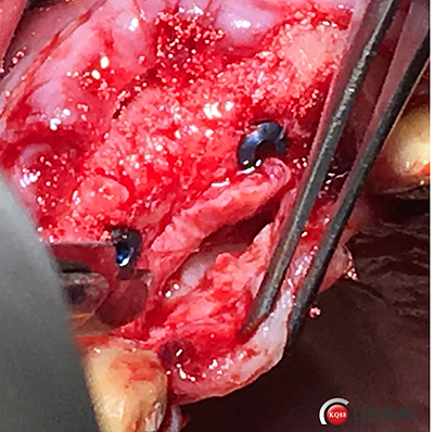 上前牙骨量不足種植+信封式植骨(梁光強(qiáng)) 上前牙骨量不足種植+信封式植骨(梁光強(qiáng))