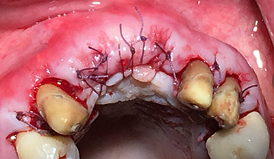 上前牙骨量不足種植+信封式植骨(梁光強(qiáng)) 上前牙骨量不足種植+信封式植骨(梁光強(qiáng))