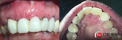 上前牙骨量不足種植+信封式植骨(梁光強(qiáng)) 上前牙骨量不足種植+信封式植骨(梁光強(qiáng))