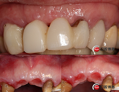 上前牙骨量不足種植+信封式植骨(梁光強(qiáng)) 上前牙骨量不足種植+信封式植骨(梁光強(qiáng))