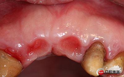 上前牙骨量不足種植+信封式植骨(梁光強(qiáng)) 上前牙骨量不足種植+信封式植骨(梁光強(qiáng))