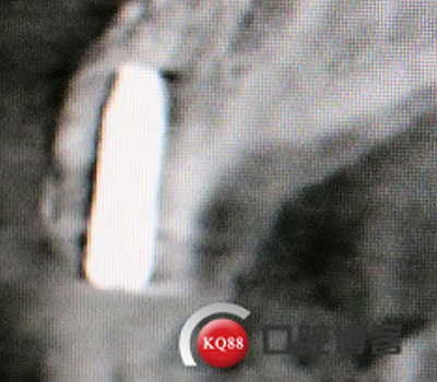 上前牙骨量不足種植+信封式植骨(梁光強(qiáng)) 上前牙骨量不足種植+信封式植骨(梁光強(qiáng))