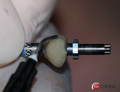 上前牙骨量不足種植+信封式植骨(梁光強(qiáng)) 上前牙骨量不足種植+信封式植骨(梁光強(qiáng))