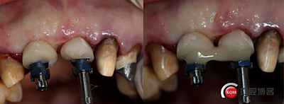 上前牙骨量不足種植+信封式植骨(梁光強(qiáng)) 上前牙骨量不足種植+信封式植骨(梁光強(qiáng))