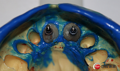 上前牙骨量不足種植+信封式植骨(梁光強(qiáng)) 上前牙骨量不足種植+信封式植骨(梁光強(qiáng))